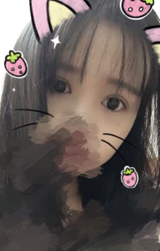 吕方中医生双眼皮手术案例
