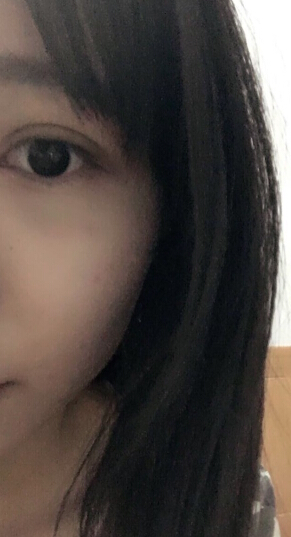 吕方中医生双眼皮手术案例