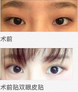 济南皓月医疗美容诊所方皓医生双眼皮手术案例