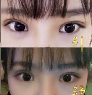 济南皓月医疗美容诊所方皓医生双眼皮手术案例