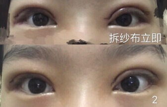 在金蓉医生处做了全切双眼皮手术案例分享