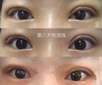 在金蓉医生处做了全切双眼皮手术案例分享