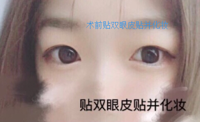 在金蓉医生处做了全切双眼皮手术案例分享