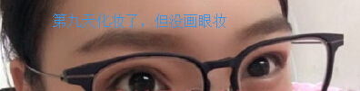 在金蓉医生处做了全切双眼皮手术案例分享