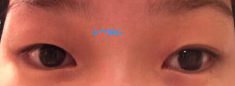 在金蓉医生处做了全切双眼皮手术案例分享