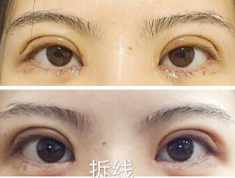 上海九院杨娴娴医生开眼角+全切双眼皮案例分享