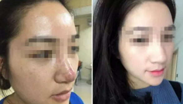 深圳博爱宋仁刚教授助玻尿酸隆鼻失败修复案例