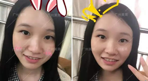 广州美莱注射水光前后对比图真实反馈