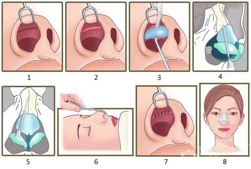 北京隆鼻手术多少钱哪家医院好手术案例对比图
