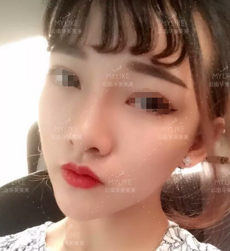 昆明华美美莱隆鼻好吗？*术后案例？