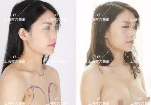 上海时光做填充怎么样 张晶医生自体脂肪隆胸案例
