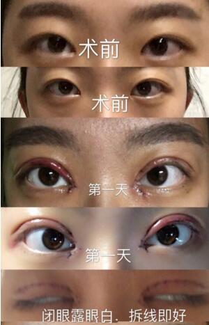 北京八大处靳小雷医生做的全切双眼皮、内眼角