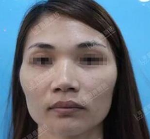 深圳丽港丽格全脸脂肪填充术前面诊及术后恢复照片