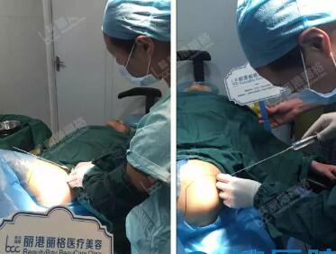 深圳丽港丽格全脸脂肪填充术前面诊及术后恢复照片
