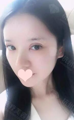 杭州格莱美陈笑双眼皮+隆鼻修复案例