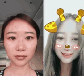 分享一个在杭州时光做完双眼皮和隆鼻刚满7天