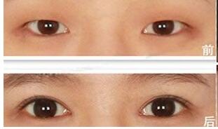 兰州亚韩和时光哪个做双眼皮好？价格表