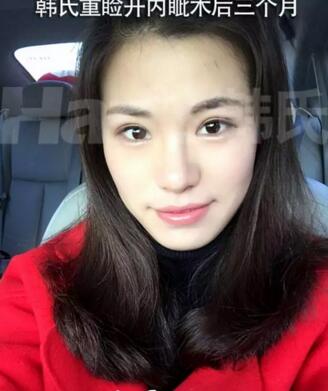 济南韩氏找郭广科做双眼皮5个月案例