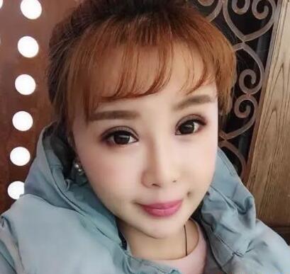 徐州华美李亚飞做双眼皮+上睑下垂矫正案例