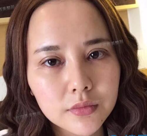 北京西美整形做完开眼角和双眼皮手术案例分享