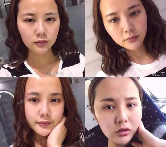 北京西美整形做完开眼角和双眼皮手术案例分享