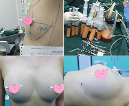 深圳易容颜医疗美容魏晓峰自体脂肪丰胸术后5个月