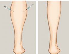 怎样瘦小腿上的肌肉见*