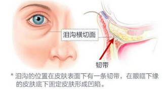 深圳自体脂肪填充泪沟价格是多少？