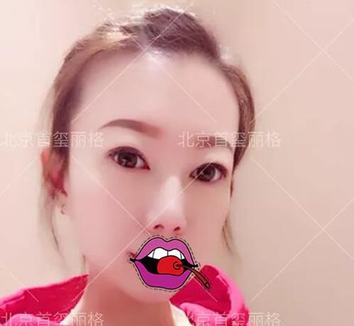北京首玺丽格做外路祛眼袋+双眼皮变年轻了