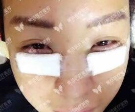 天津紫洁医疗美容医院王椿燕医生非手术去眼袋案例