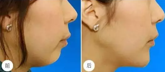 下巴不好看怎么办?