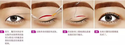 双眼皮的做法大全,你真的知道自己适合做什么样的双眼皮?