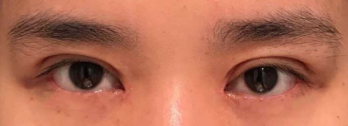 武汉美基元项利姣双眼皮加内眼角加健膜矫正