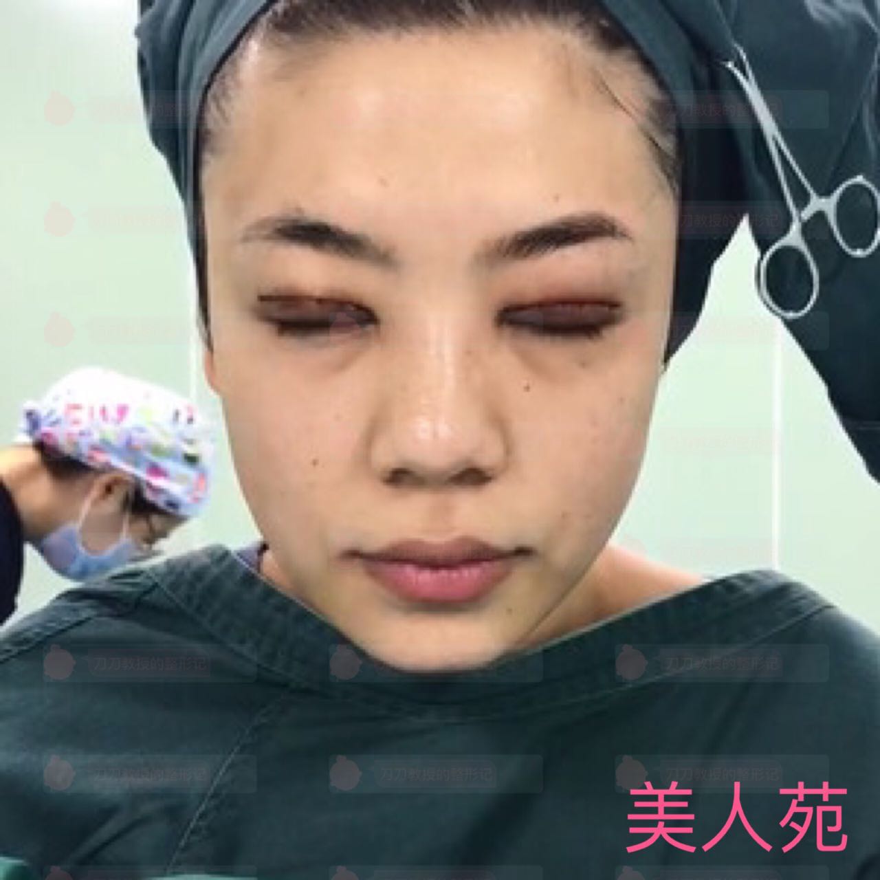 北京八大处双眼皮修复案例,小姐姐恢复相当*