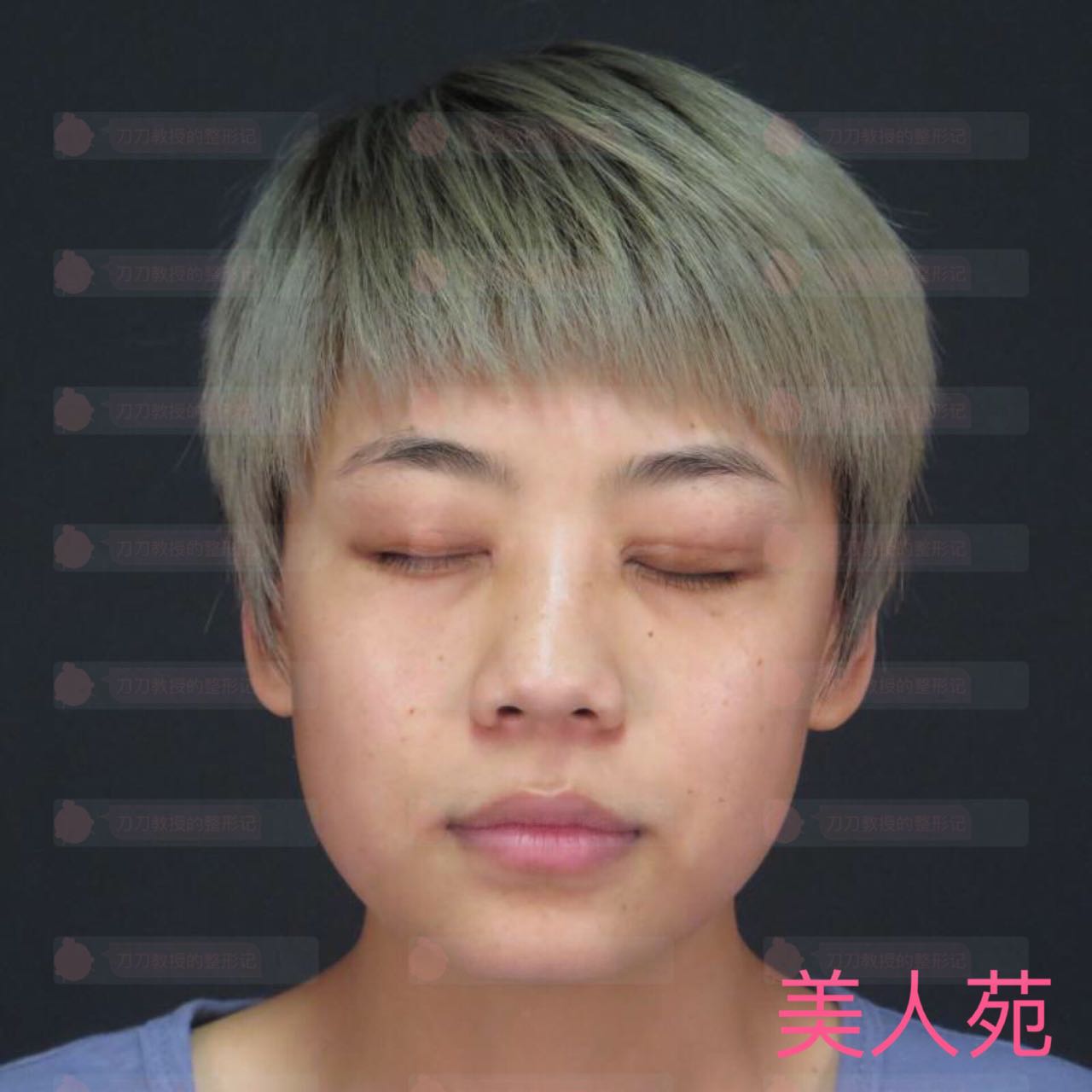 北京八大处双眼皮修复案例，小姐姐恢复相当*
