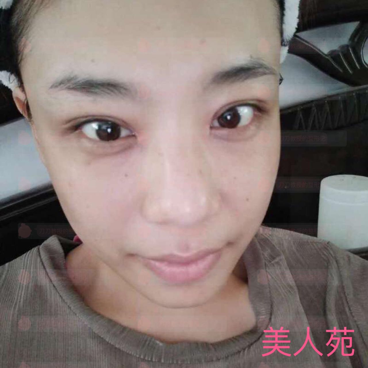 北京八大处双眼皮修复案例，小姐姐恢复相当*