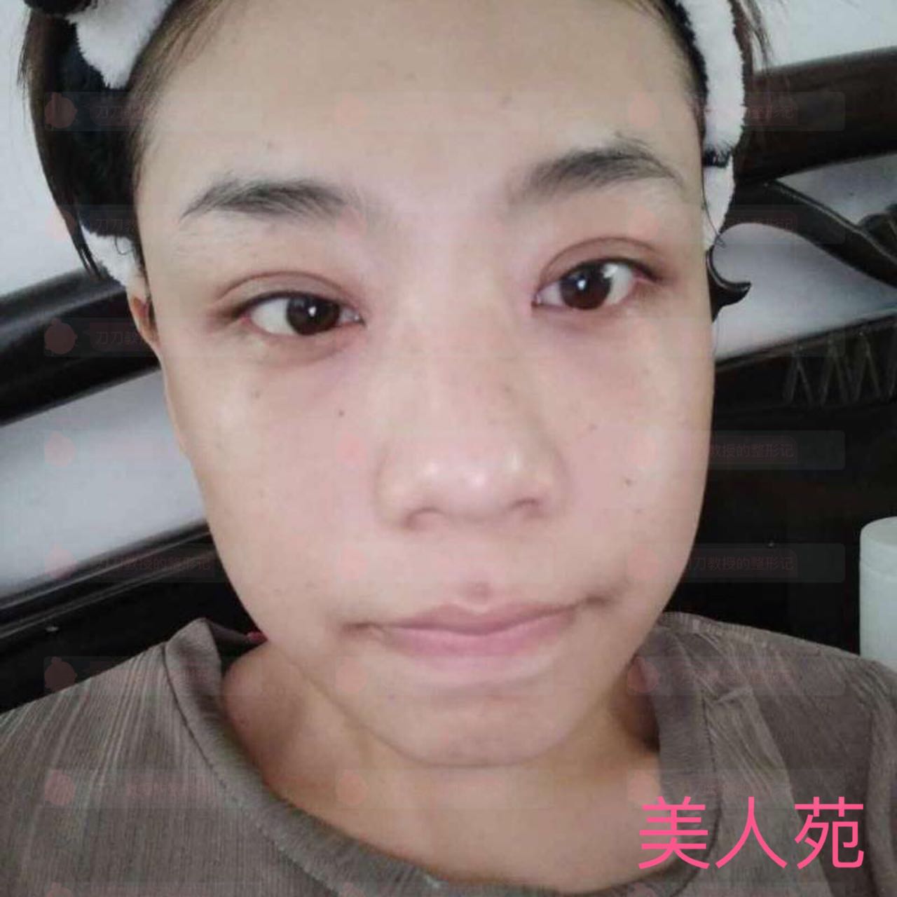 北京八大处双眼皮修复案例,小姐姐恢复相当*