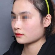 北京【V-LINE瓜子脸手术】