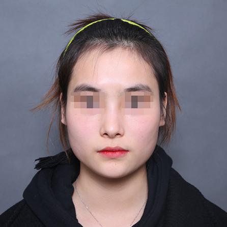 北京【V-LINE瓜子脸手术】下颌角磨骨案例价格分享