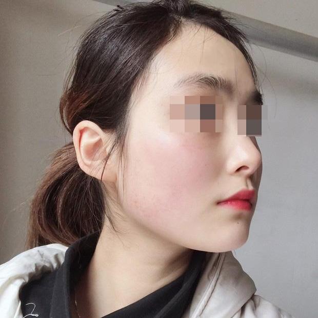 北京【V-LINE瓜子脸手术】下颌角磨骨案例价格分享