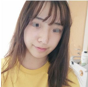 脸大的我被苏州薇琳狄峰医生批评了,盲目打*并不适合面部脂肪过多